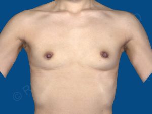 before breast augmentation front view case 3474
