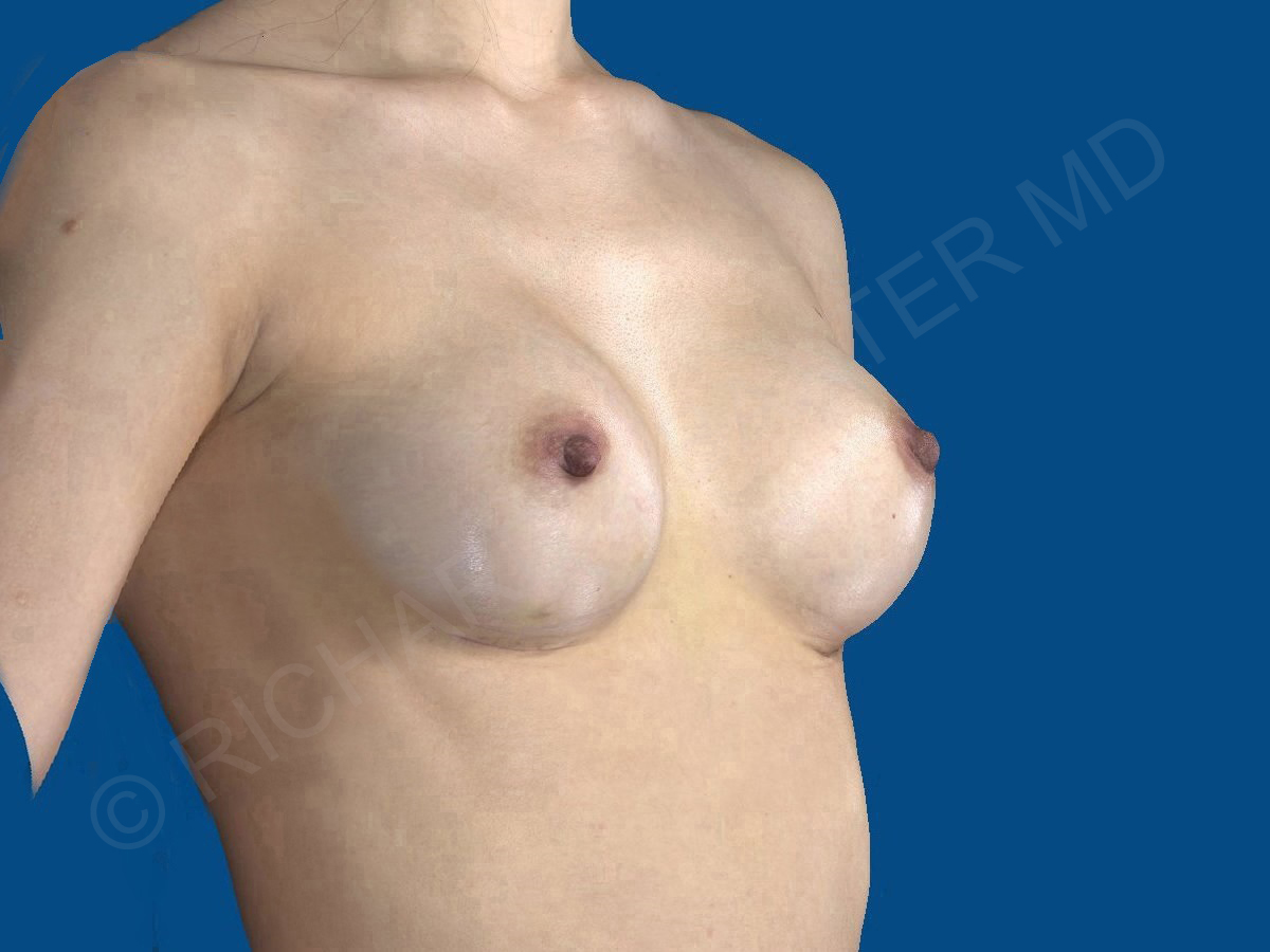 after breast augmentation angle view case 3474