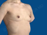 before breast augmentation angle view case 3474