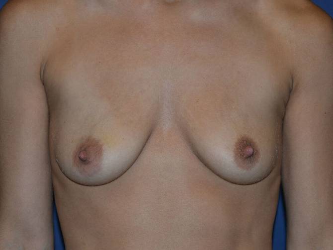 before breast augmentation front view case 3415