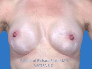 after breast augmentation front view case 3305