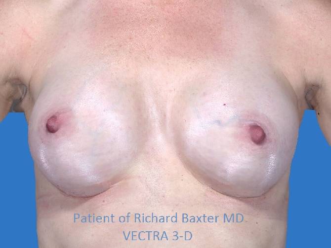 after breast augmentation front view case 3305