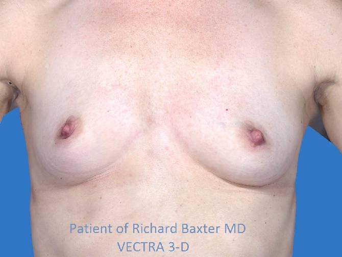 before breast augmentation front view case 3305