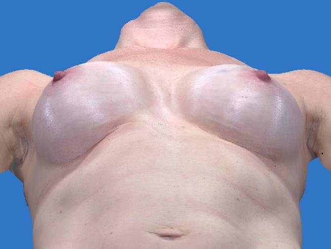 after breast augmentation lying down view case 3305