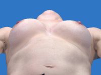 before breast augmentation lying down view case 3305