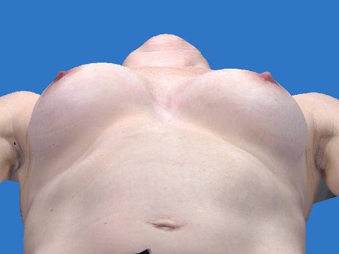 before breast augmentation lying down view case 3305
