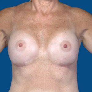 after breast augmentation front view case 3352