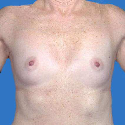 before breast augmentation front view case 3352
