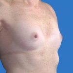 before breast augmentation right angled view case 3352