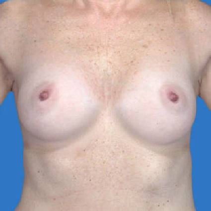 before breast augmentation front view case 3352