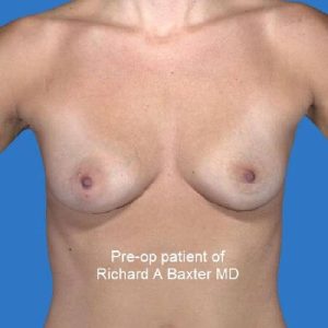 before breast augmentation front view case 3298