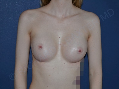 after breast augmentation front view case 3115