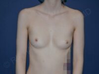 before breast augmentation front view case 3115