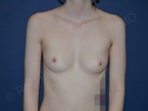before breast augmentation front view case 3115