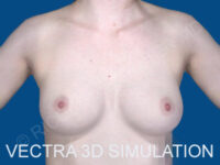 after breast augmentation Vectra 3D Simulation front view