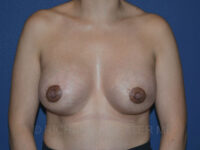 after breast augmentation front view case 3153
