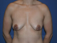 before breast augmentation front view case 3153