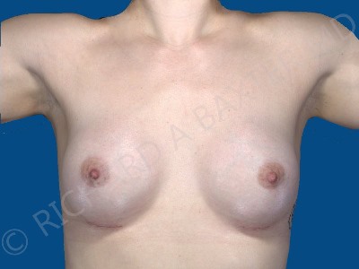 after breast augmentation front view case 3202