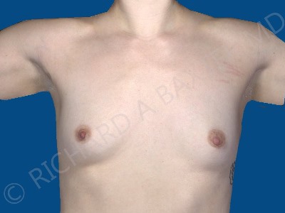 before breast augmentation front view case 3202