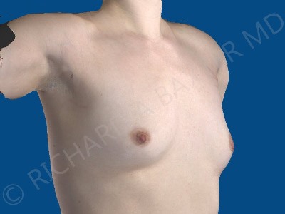 before breast augmentation right angled view case 3202