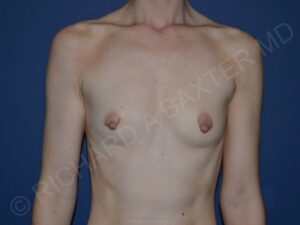 before breast augmentation front view case 3225