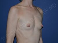 before breast augmentation right angled view case 3225