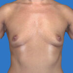 before breast augmentation front view case 3244