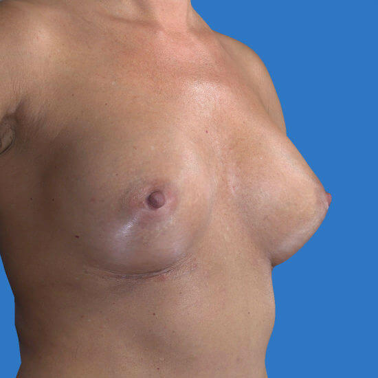 after breast augmentation right angled view case 3244