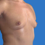 before breast augmentation right angled view case 3244