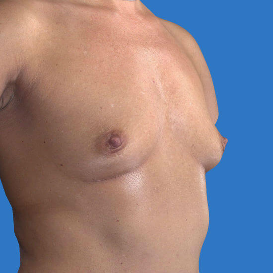 before breast augmentation right angled view case 3244