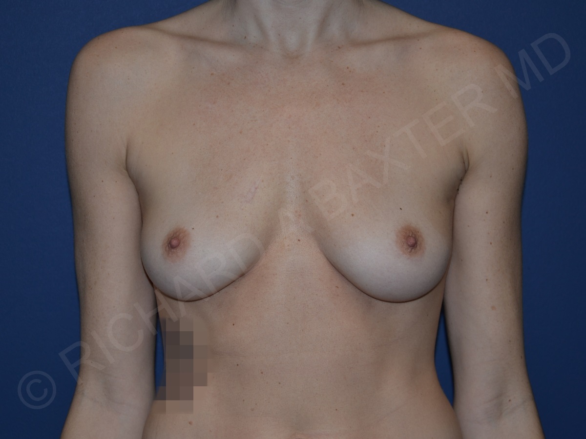 before breast augmentation front view case 3256