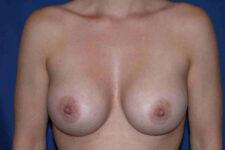 after breast augmentation front view case 3261