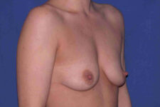 before breast augmentation angle view case 3261