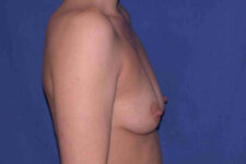 before breast augmentation side view case 3261