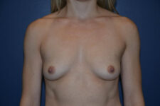 before breast augmentation front view case 3268