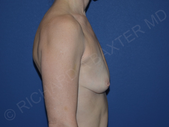 before breast augmentation right side view case 3293