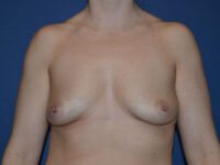 before breast augmentation front view case 3310