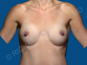after breast augmentation front view case 3320