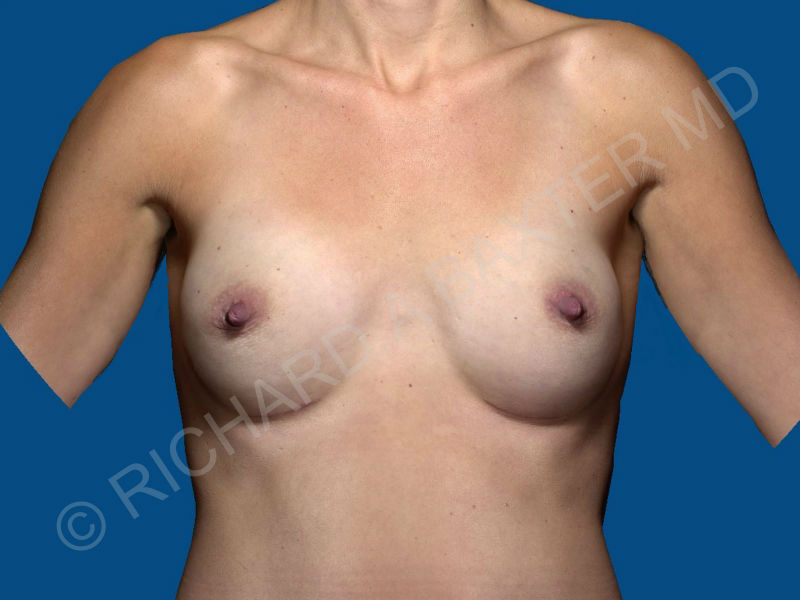 after breast augmentation front view case 3320