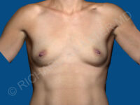 before breast augmentation front view case 3320