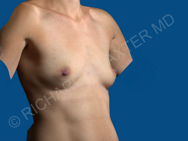 before breast augmentation angle view case 3320