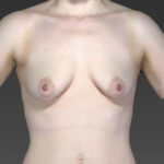 before breast augmentation front view female patient case 3330