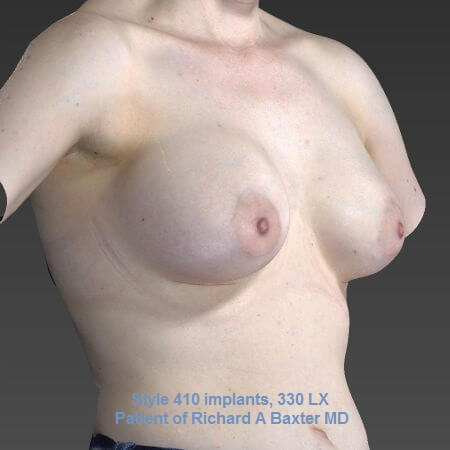 after breast augmentation angle view female patient case 3330