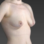 before breast augmentation angle view female patient case 3330