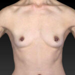before breast augmentation front view case 3389