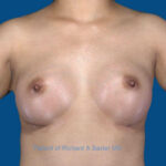 after breast augmentation front view case 3399