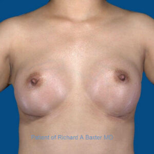 after breast augmentation front view case 3399