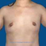 before breast augmentation front view case 3399
