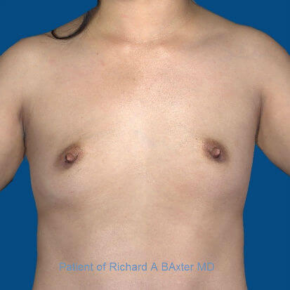before breast augmentation front view case 3399