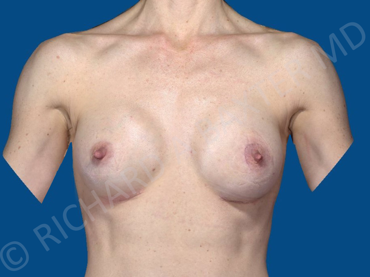 after breast augmentation front view case 3410